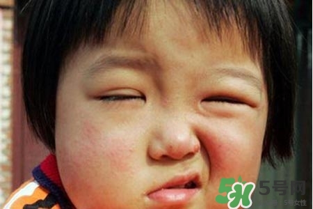 青少年面癱是怎么回事？青少年面癱是怎么辦？