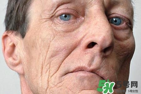 老年人為什么容易得面癱？老年人面癱原因有哪些？