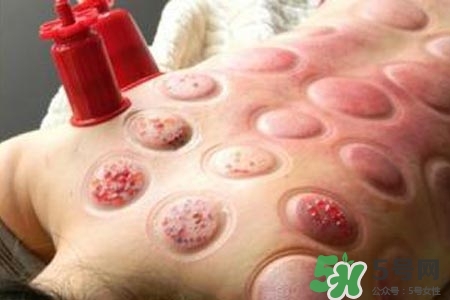 拔罐放血對身體好嗎？拔罐放血有什么好處？
