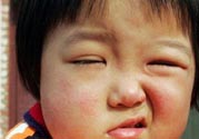 如何預防面癱復發(fā)？導致面癱的四大原因