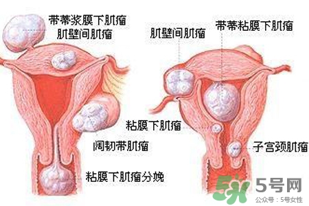 子宮小會(huì)影響生育嗎？子宮小會(huì)導(dǎo)致不孕嗎？
