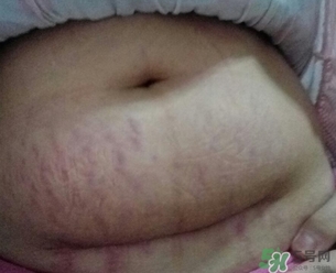 孕婦肚子上的黑線(xiàn)能看出生男生女嗎?