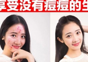 伊詩蘭頓祛痘怎么樣？伊詩蘭頓祛痘膏有用嗎？
