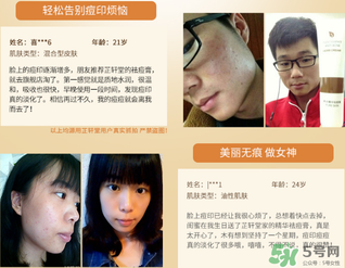 芷軒堂祛痘有效果嗎？芷軒堂祛痘印效果怎么樣？