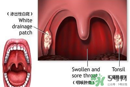 口含大蒜能治療咽炎嗎？巧用大蒜治療咽炎咳嗽