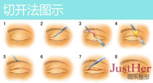 定點雙眼皮怎么做？定點雙眼皮需要拆線嗎？