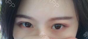 定點雙眼皮能保持多久？定點雙眼皮是永久的嗎？
