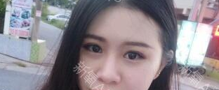 定點雙眼皮能保持多久？定點雙眼皮是永久的嗎？