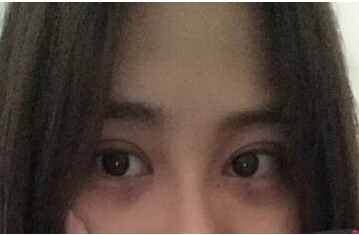 定點雙眼皮怎么做？定點雙眼皮需要拆線嗎？
