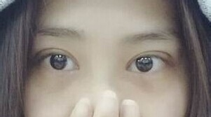 定點雙眼皮怎么做？定點雙眼皮需要拆線嗎？