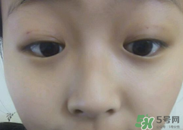 埋線雙眼皮需要拆線嗎？埋線雙眼皮怎么拆線