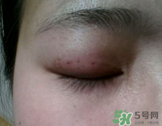 埋線雙眼皮需要拆線嗎？埋線雙眼皮怎么拆線