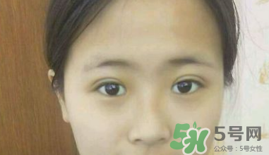 埋線雙眼皮需要拆線嗎？埋線雙眼皮怎么拆線