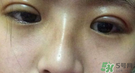 埋線雙眼皮需要拆線嗎？埋線雙眼皮怎么拆線