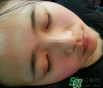埋線雙眼皮需要拆線嗎？埋線雙眼皮怎么拆線