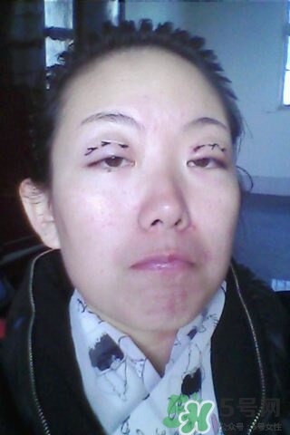 什么是定點雙眼皮？定點雙眼皮多少錢？