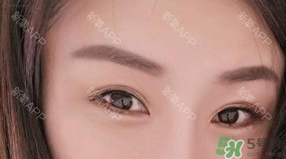 埋線雙眼皮能保持多久？埋線雙眼皮是永久嗎