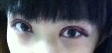 韓式三點(diǎn)雙眼皮是永久嗎？三點(diǎn)雙眼皮能保持多久？