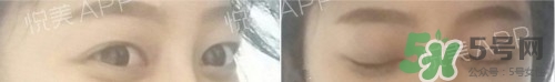 埋線雙眼皮多久恢復(fù)自然？埋線雙眼皮多久能恢復(fù)