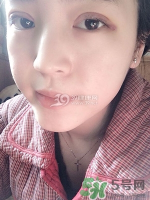 什么是定點雙眼皮？定點雙眼皮多少錢？
