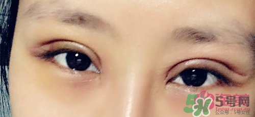 切開雙眼皮多久消腫？切開雙眼皮多久恢復(fù)？