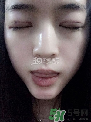 什么是定點雙眼皮？定點雙眼皮多少錢？