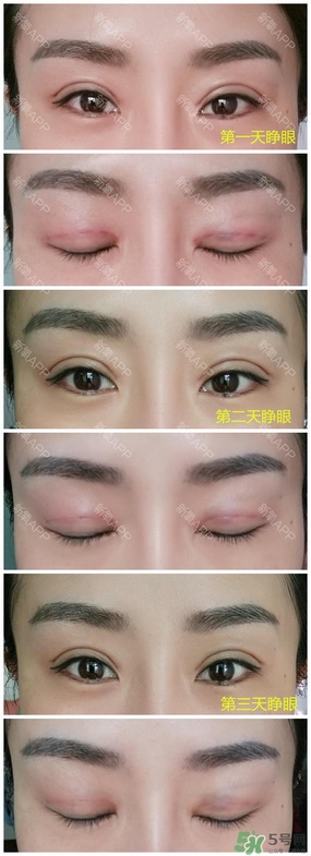 埋線雙眼皮能保持多久？埋線雙眼皮是永久嗎