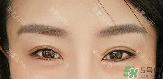 埋線雙眼皮能保持多久？埋線雙眼皮是永久嗎