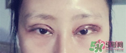 切開雙眼皮多久消腫？切開雙眼皮多久恢復(fù)？