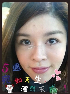 重瞼術是什么？重瞼術是永久的嗎？