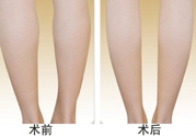 小腿吸脂多久見(jiàn)效？小腿吸脂后多久能看見(jiàn)效果？