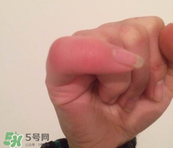 小拇指凍腫了怎么辦？為什么小拇指容易凍？