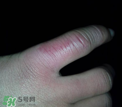 小拇指凍腫了怎么辦？為什么小拇指容易凍？