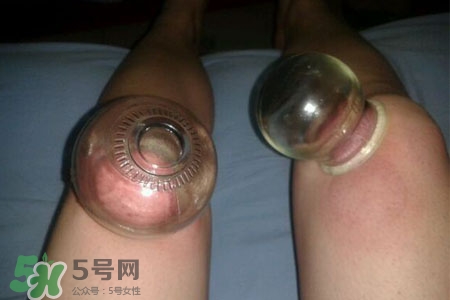 小腿能拔罐嗎？在小腿上拔火罐有什么作用？