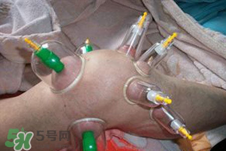 小腿能拔罐嗎？在小腿上拔火罐有什么作用？