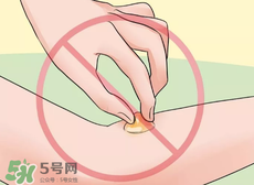 水泡怎么處理？水泡要不要刺破？
