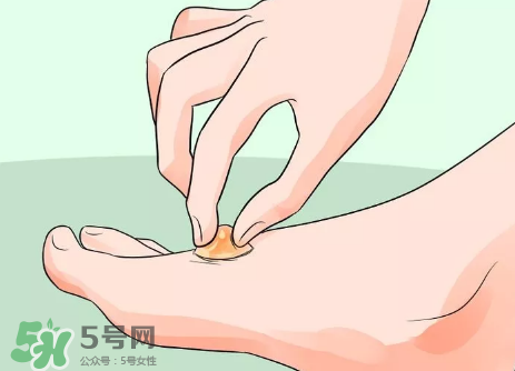 水泡怎么處理？水泡要不要刺破？