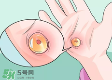 水泡怎么處理？水泡要不要刺破？
