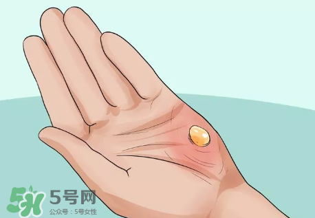 水泡怎么處理？水泡要不要刺破？