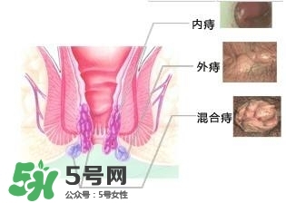 痔瘡吃什么藥效果好？痔瘡吃什么藥好得快？