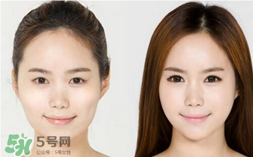 瘦臉針?lè)譃閹追N類型？瘦臉針有哪幾個(gè)牌子？