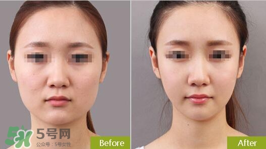 瘦臉針?lè)譃閹追N類型？瘦臉針有哪幾個(gè)牌子？