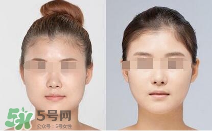 瘦臉針?lè)譃閹追N類型？瘦臉針有哪幾個(gè)牌子？