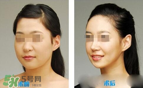 瘦臉針?lè)譃閹追N類型？瘦臉針有哪幾個(gè)牌子？
