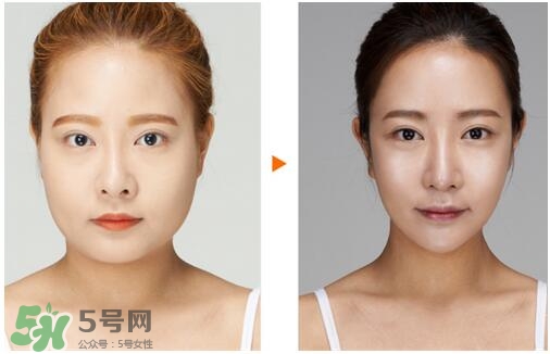 瘦臉針?lè)譃閹追N類型？瘦臉針有哪幾個(gè)牌子？