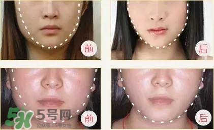 打完瘦臉針多久可以化妝？打完瘦臉針的反應