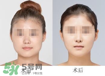 打瘦臉針能喝酒嗎？打瘦臉針能吃海鮮嗎？