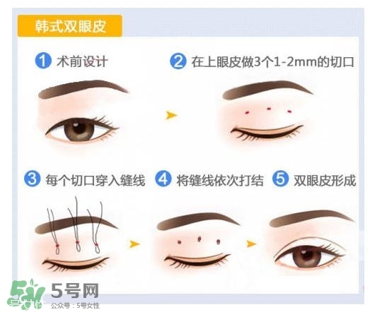 割雙眼皮有幾種做法？雙眼皮有哪幾種形狀？