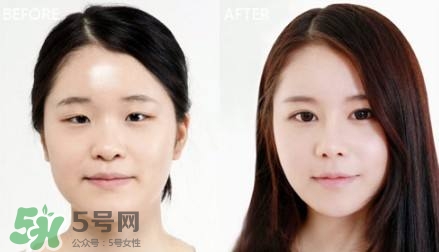 割雙眼皮有什么后遺癥嗎？割雙眼皮有什么危害性？