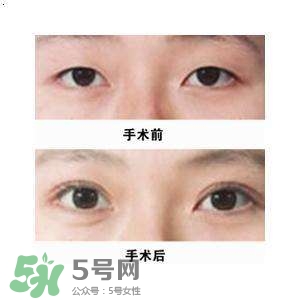 割雙眼皮疼不疼？割雙眼皮疼幾天能好？